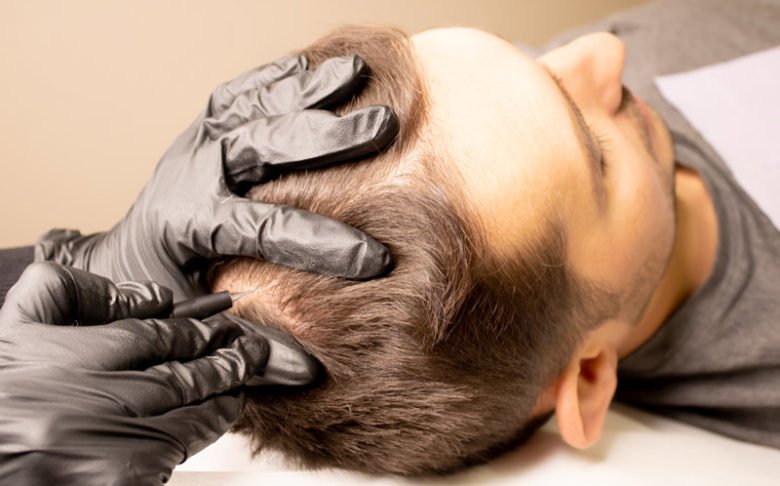Трихопигментация волос: перманентный макияж головы